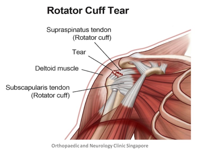 torn ligament in rotator cuff